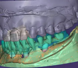 Digital arch planning with implants.