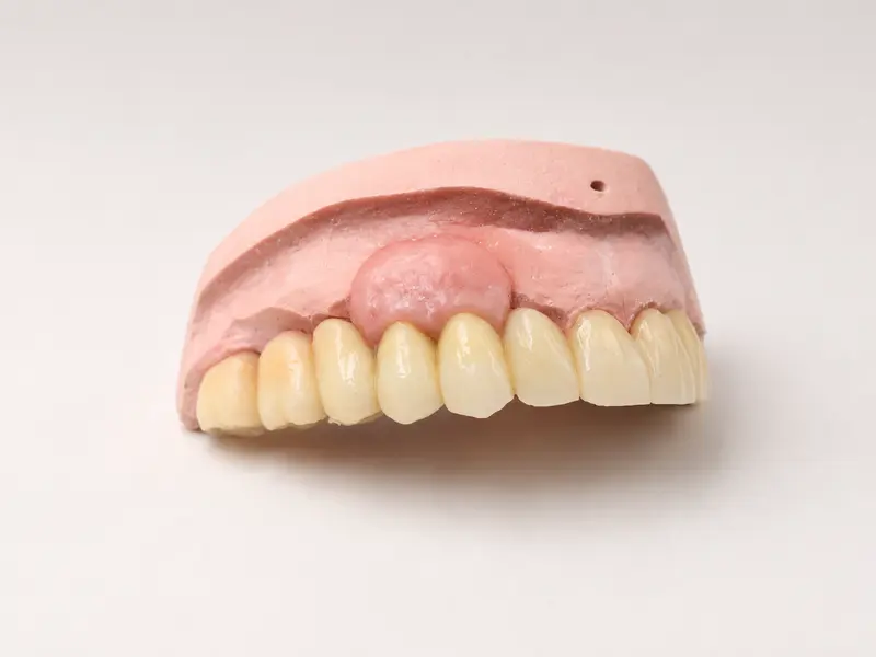 Implant-supported restoration.