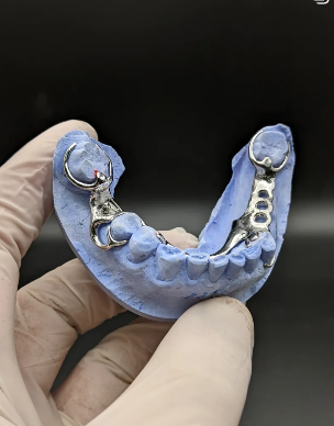 Pròtesi removible metàl·lica.